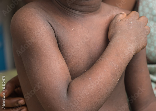 Close up shot of an African child's body, with unhealthy spots, heat rashes, eczema, shingles, Dermatitis or blemishes on the skin, which can also cause itching