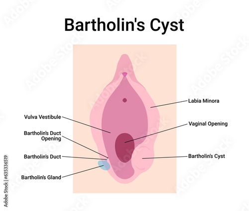 Bartholin's Cyst Medical Vector Illustration