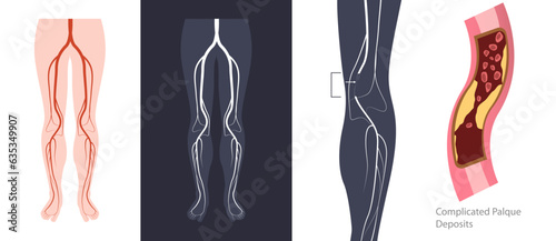 Cholesterol deposits plaques in the heart arteries and inflammation are usually the cause of coronary artery disease. Artery blockage vector illustrations. Angiography image of artery. Clogged artery. photo