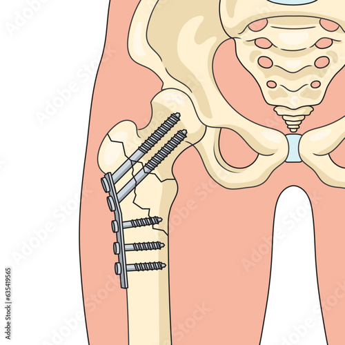Internal fixation operation in orthopedics surgical repairing bone diagram schematic vector illustration. Medical science educational illustration
