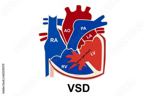  The picture show the structure of congenital heart disease which is ventricular septal defect or VSD and show the left to right shunt of blood that happen from VSD for medical and study 