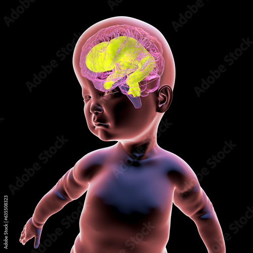 Fotografie A baby with macrocephaly and enlarged brain ventricles, 3D illustration