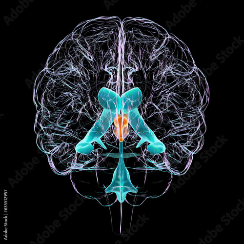 Slika na platnu Enlarged third ventricle of the brain, 3D illustration