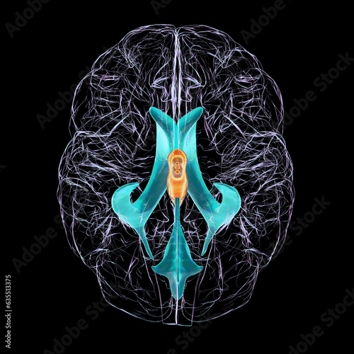 Fotografie Enlarged third ventricle of the brain, 3D illustration
