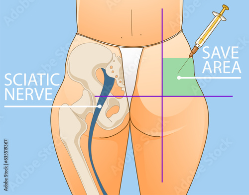 Beauty injections. Non-surgical correction. Save area. Sciatic nerve. Healthcare illustration. Beauty illustration. Vector illustration.  photo
