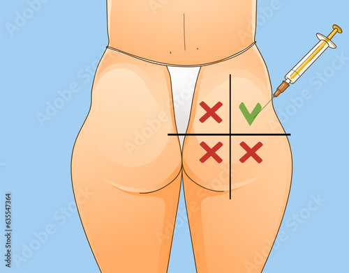 Beauty injections. Non-surgical correction. Save area. Sciatic nerve. Healthcare illustration. Beauty illustration. Vector illustration. 