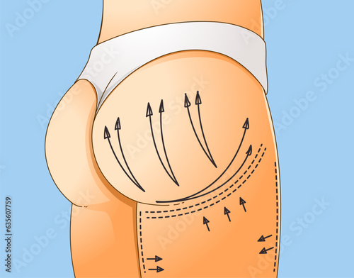 Buttocks Enhancement. Non-surgical correction. Save area. Sciatic nerve. Healthcare illustration. Beauty illustration. Vector illustration.  photo
