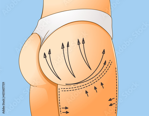 Buttocks Enhancement. Non-surgical correction. Save area. Sciatic nerve. Healthcare illustration. Beauty illustration. Vector illustration. 