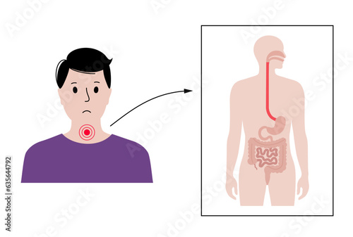 Dysphagia medical poster