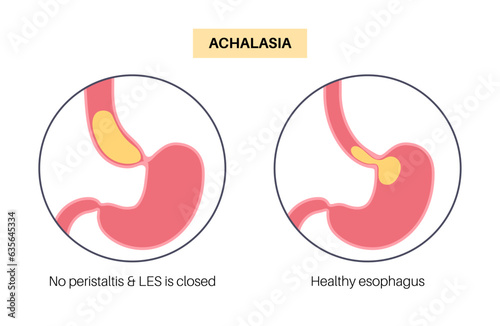 Esophageal achalasia disease
