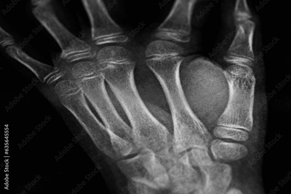 x-ray of the hands, detail of the phalanges and joints,trapeze,scaphoid,Pyramidal,Pisiform,capitate, distal, frontal, proximal, interflaginian, lunate, intercapitate x-ray of the hands, detail of the phalanges and joints,trapeze,scaphoid,Pyramidal,Pisiform,capitate, distal, frontal, proximal, interflaginian, lunate, intercapitate