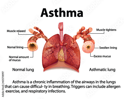 Comparing Normal and Asthma Lungs in Medical Education
