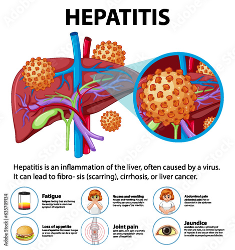 Human Anatomy: Liver with Hepatitis and Symptoms