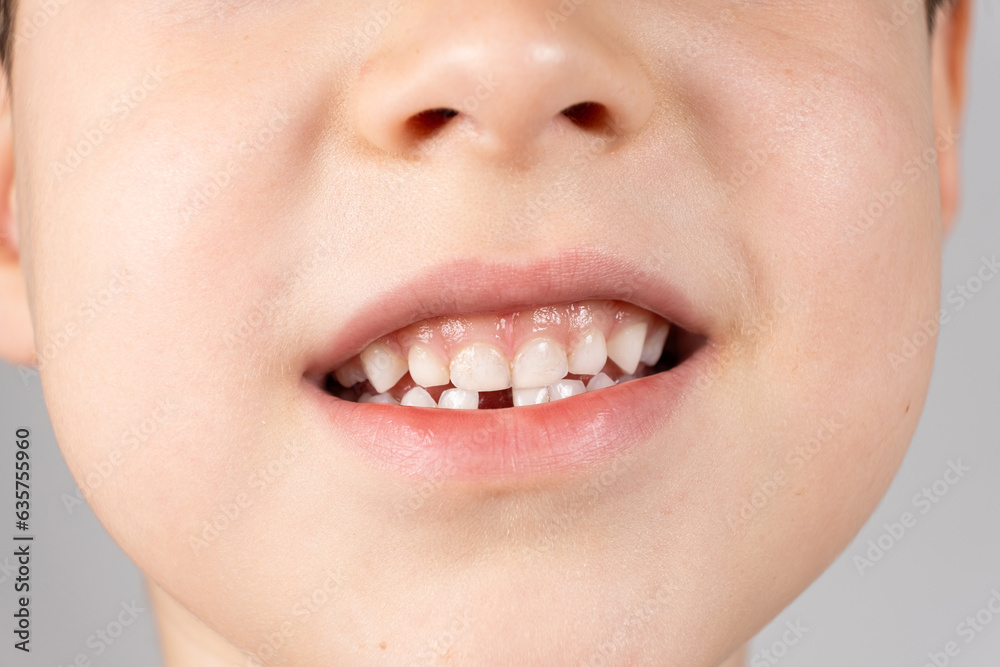 Loss of milk teeth in children. A six-year-old child shows the first baby tooth that has fallen out Loss of milk teeth in children. A six-year-old child shows the first baby tooth that has fallen out