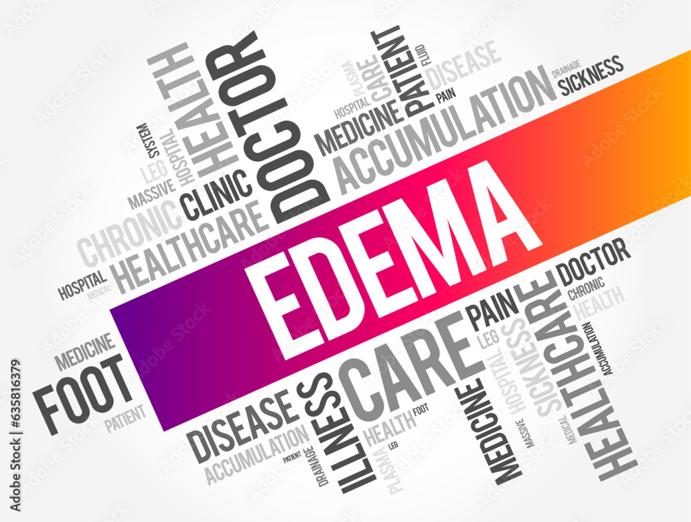 Edema is swelling caused by excess fluid trapped in your body's tissues