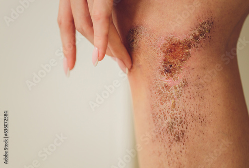 two scratch wound on female knee with big scar closeup, healthcare and medicine concept.