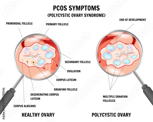 Polycystic ovary syndrome gynecology infographic in vector, PCOS symptoms 