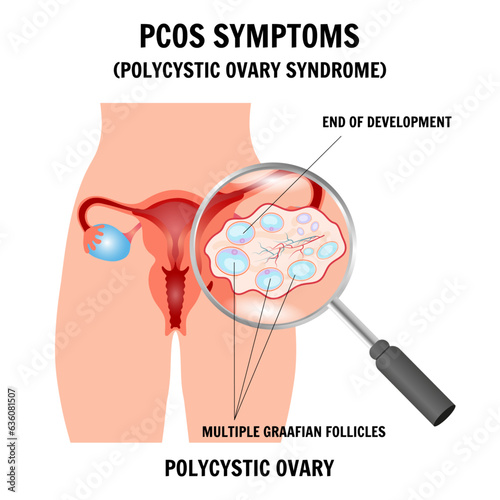 PCOS symptoms, polycystic ovary syndrome medical infographic in vector