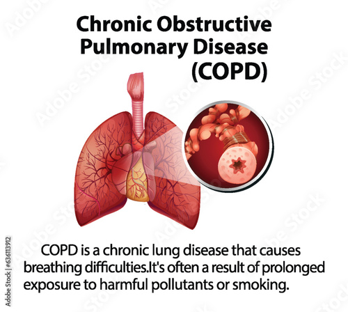 Science Education of Human Anatomy: COPD Infographic