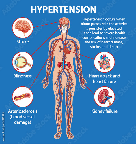 Science Education on Hypertension's Effects on Human Anatomy