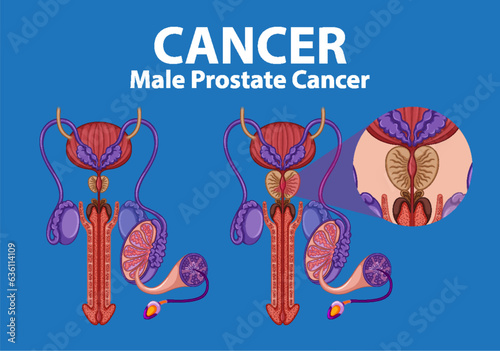 Comparison of Normal and Cancerous Prostate in Infographic