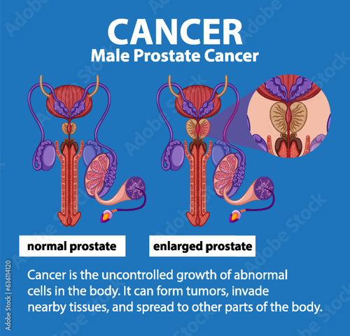Comparison of Normal and Cancerous Prostate in Infographic