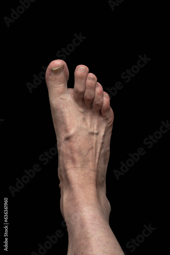 Toenail fungal infection