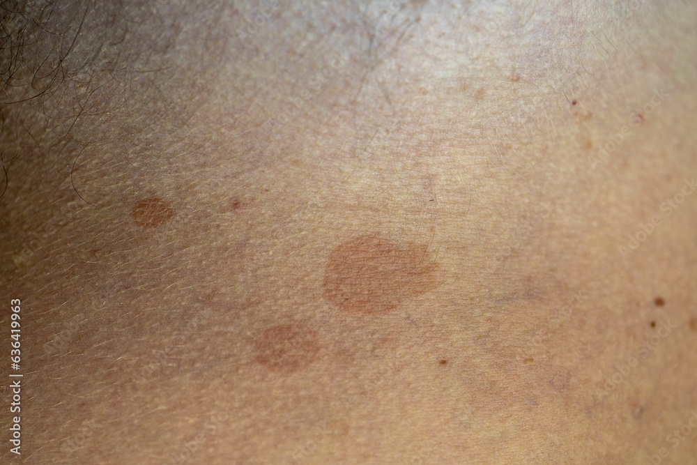 Man suffering from the skin condition Tinea Versicolor with discolored patches on the skin