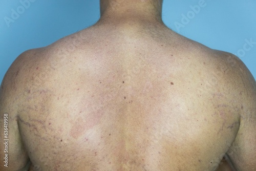 Man suffering from the skin condition Tinea Versicolor with discolored patches on the skin photo