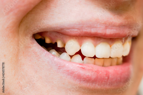 Woman's teeth before prosthetics. Full mouth