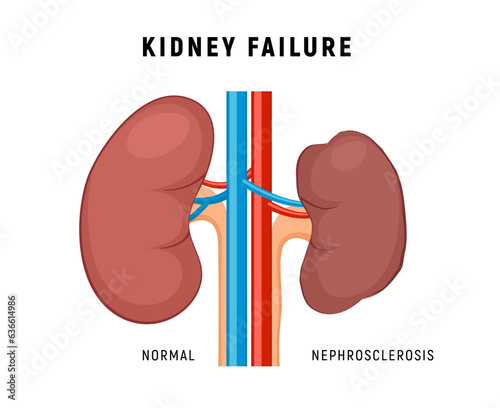 Kidney failure chronic disease urinary renal cancer. Kidney failure nephritis nephrosclerosis. photo