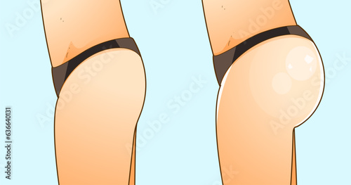 Beauty injections. Non-surgical correction. Before, after. Healthcare illustration. Beauty illustration. Vector illustration. 