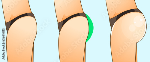 Beauty injections. Non-surgical correction. Before, after. Healthcare illustration. Beauty illustration. Vector illustration. 