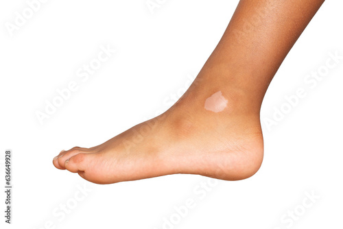 Vitiligo spot on a child's foot © Alessandro Grandini
