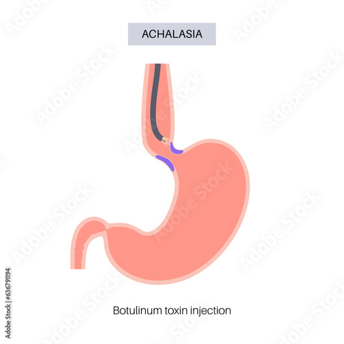 esophageal botulinum toxin injection