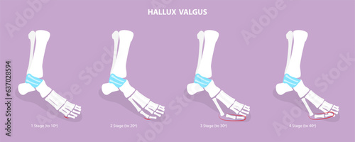 3D Isometric Flat Vector Conceptual Illustration of Hallux Valgus, Bunion in Foot