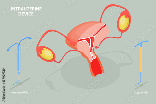3D Isometric Flat Vector Conceptual Illustration of Intrauterine Device, Birth Control