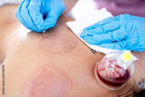 Hijama master performing wet cupping treatment on woman's body. Holding razor blade and cutting skin. photo