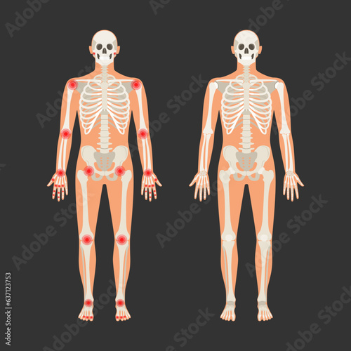 Human skeleton with pain points in rheumatoid arthritis. Men anatomy illustration with a body silhouette. Vector isolated flat of skull and bones in body photo