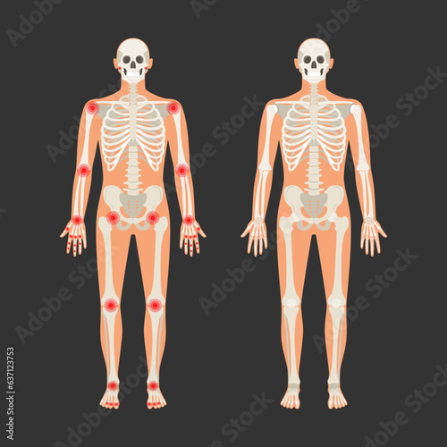 Human skeleton with pain points in rheumatoid arthritis. Men anatomy illustration with a body silhouette. Vector isolated flat of skull and bones in body