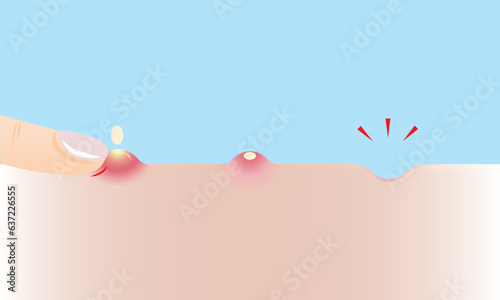 Step of squeeze acne to rolling scar vector illustration on sky blue background. The inflammatory acne, pustule on skin, squeeze pimple with finger to acne scar. Before and after skin care concept.