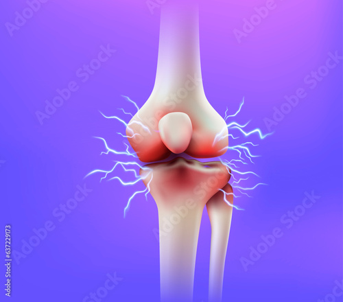 Knee joint pain and tendon problems. inflammatory disease of the knee joint concept. 3d realistic vector file.