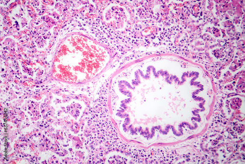 Lobar pneumonia in red hepatic phase, light micrograph photo