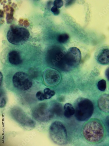 Blastomyces fungal organisms in skin biopsy specimen