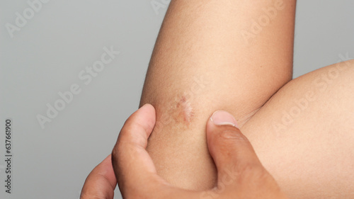 Scar on human skin keloid on elbow.