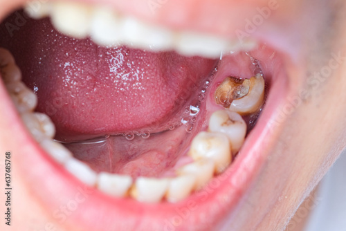 Tooth's a man smoking bad. woman smokes a cigarettes have tooth decay and calculus on teeth, So we should be care dental with the hygiene