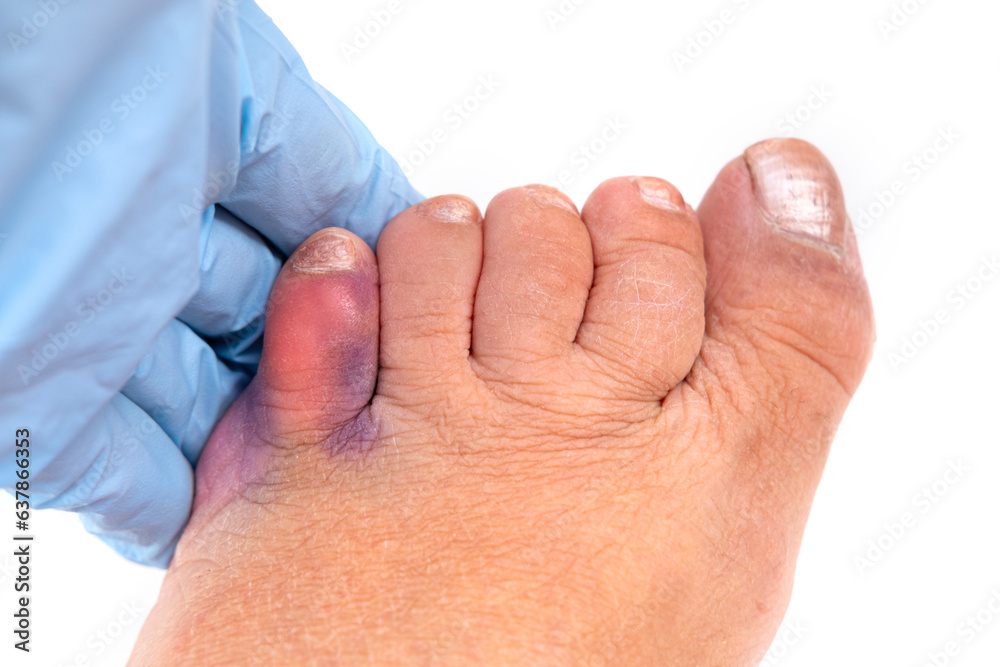 traumatologist examines injured little toe, concept of fracture, bruise