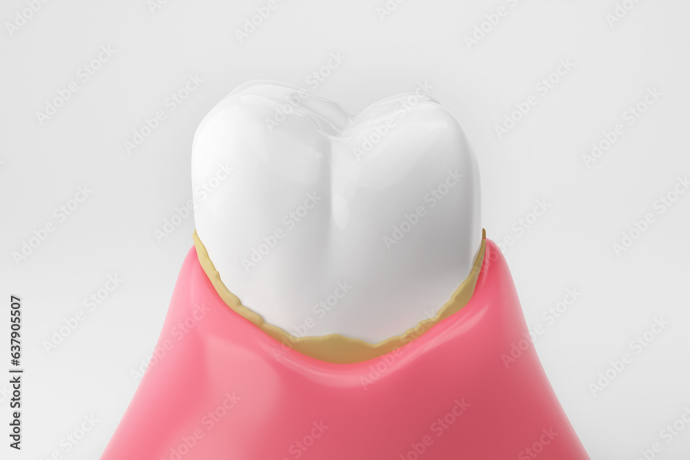 Dental calculus white teeth and gums isolated white background 3D ...