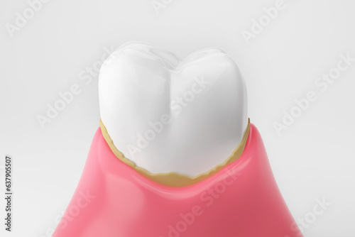 Fotografie Dental calculus white teeth and gums isolated white background 3D rendering