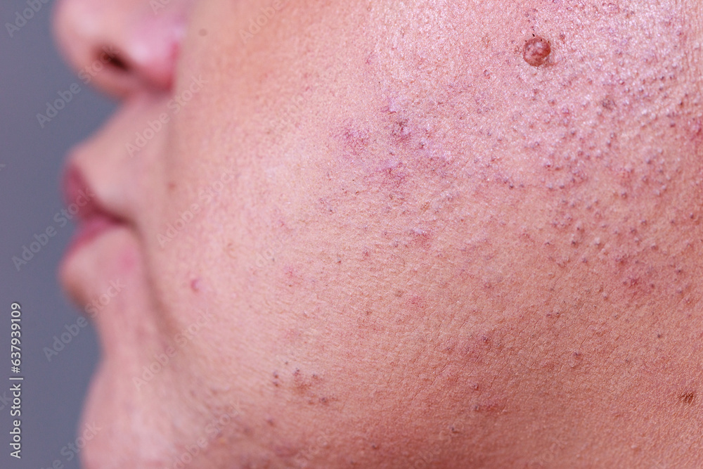 Skin face after removing hair Skin face after removing hair